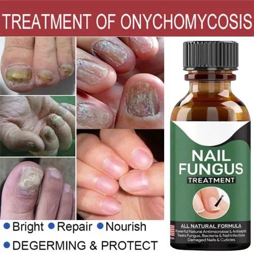 Fast Nail Fungal Treatments Nail Repair Essences Serum Care