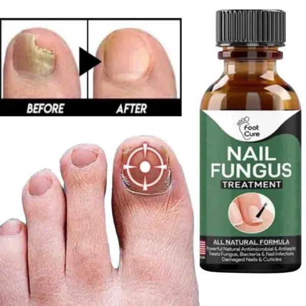 Fast Nail Fungal Treatments Nail Repair Essences Serum Care